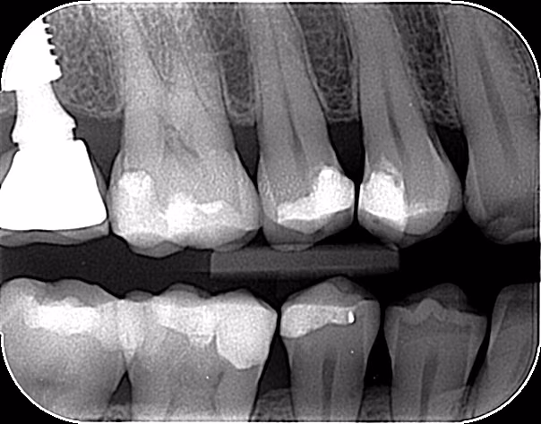 Radiografia interproximal para avaliação de cáries dentais