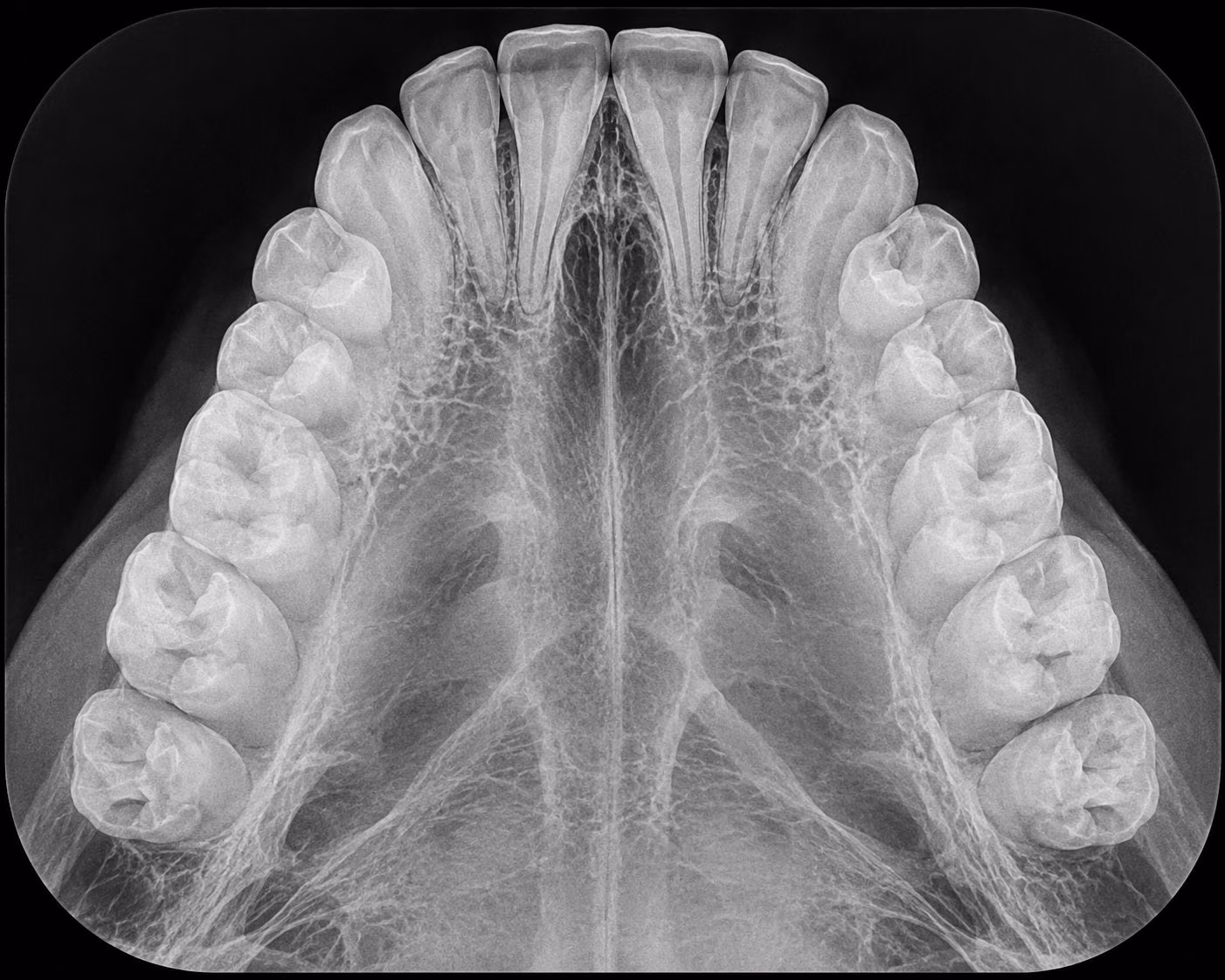 Radiografia oclusal da arcada superior para avaliação da sutura palatina