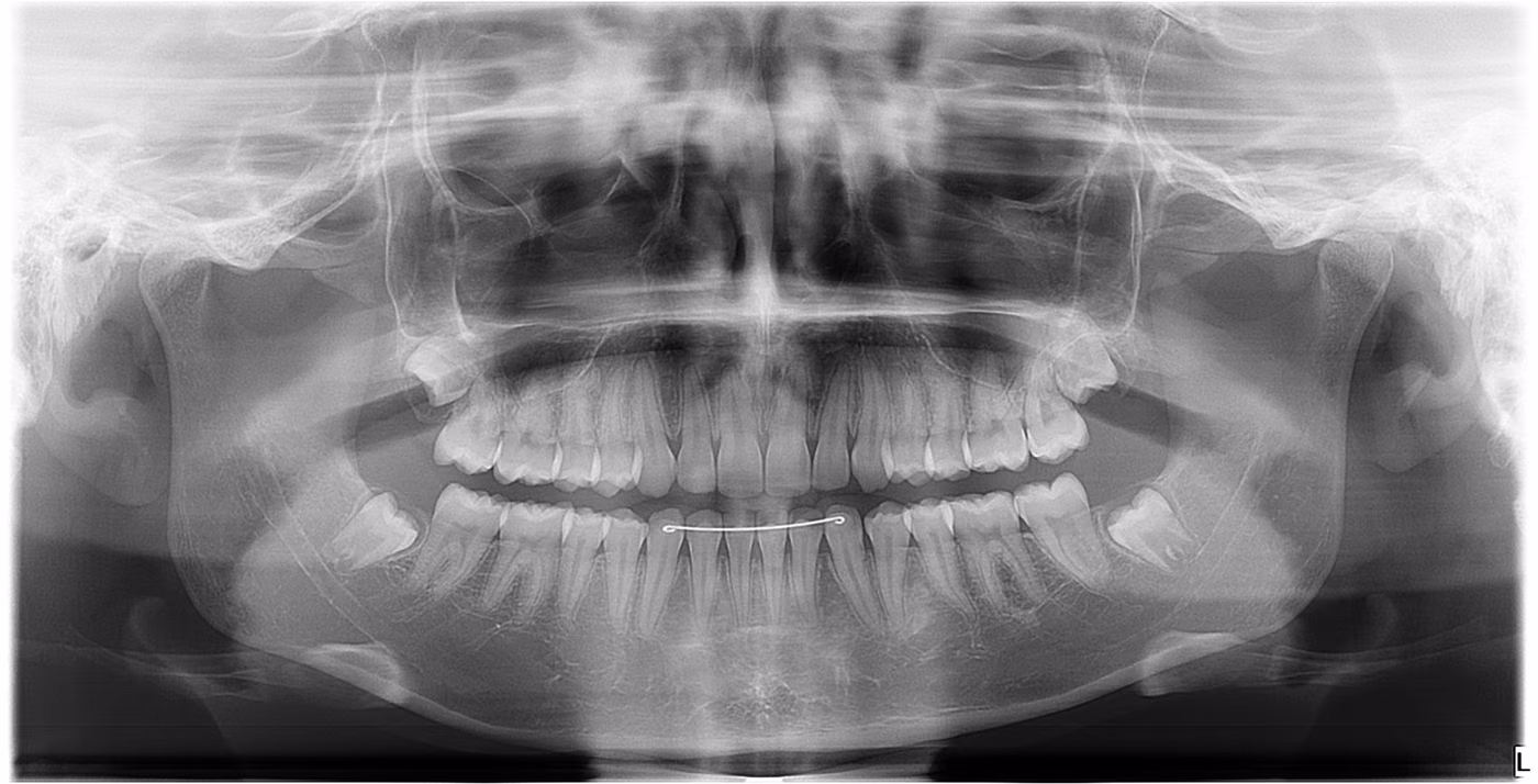 Radiografia panorâmica odontológica das arcadas dentárias