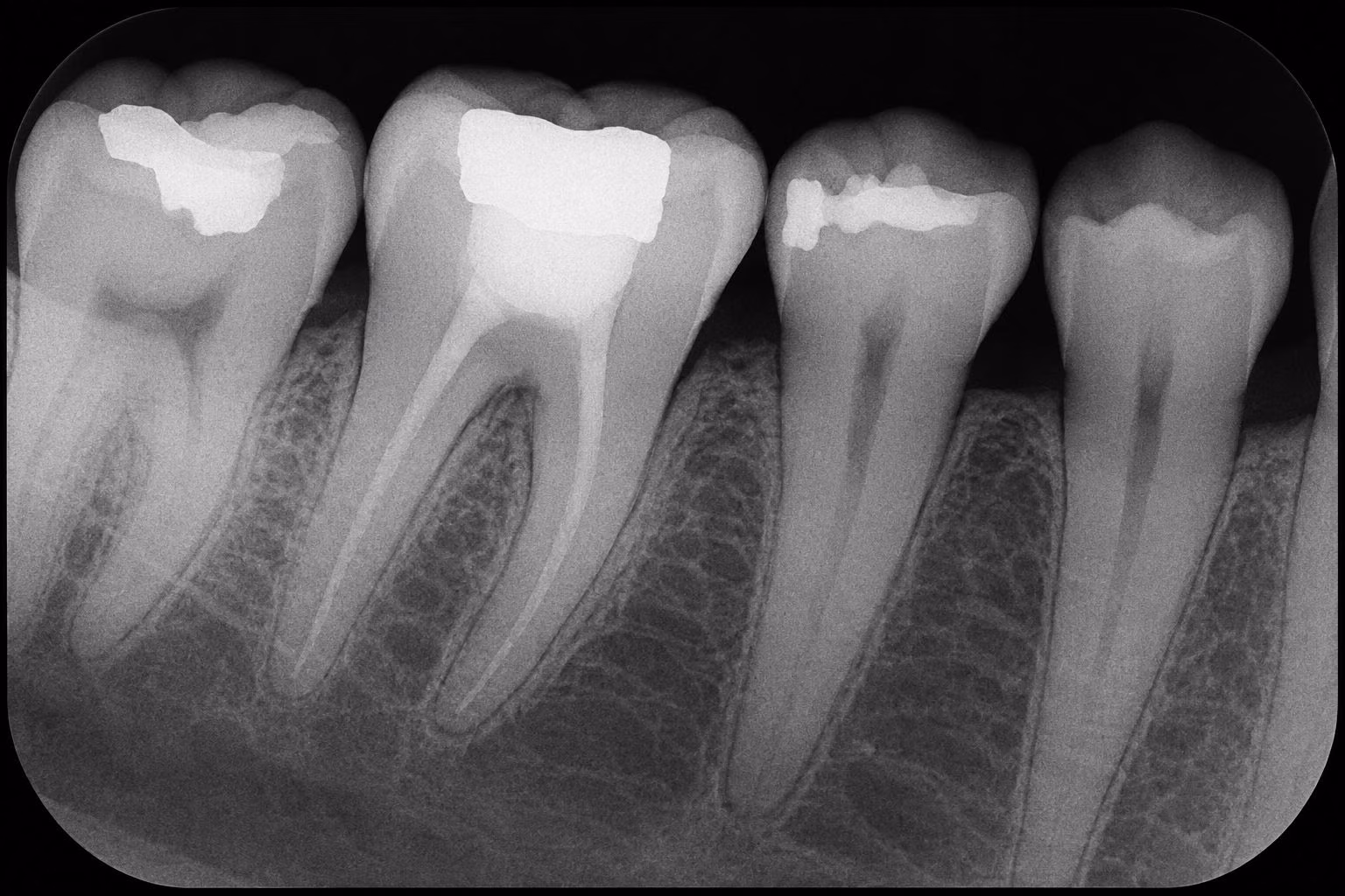 Radiografia periapical com detalhamento das raízes e coroas dentárias