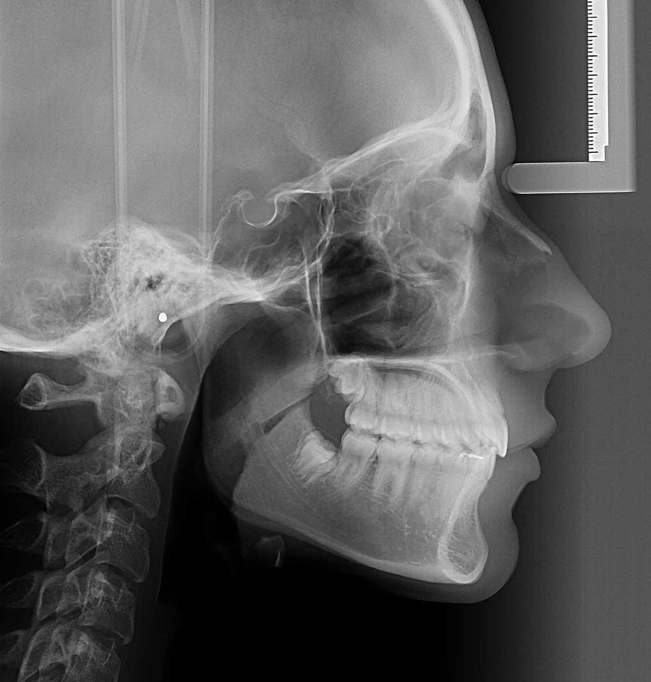 Telerradiografia lateral do crânio para avaliação cefalométrica